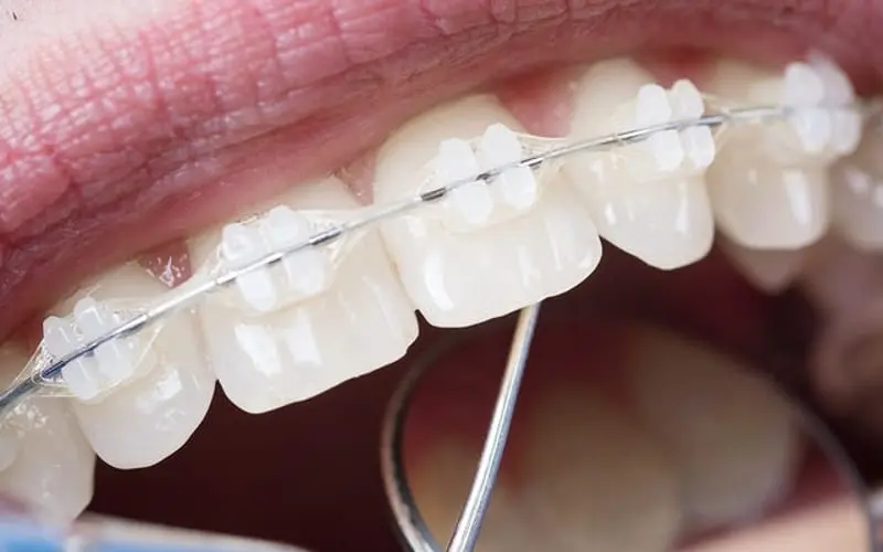 Clear ceramic braces on upper teeth