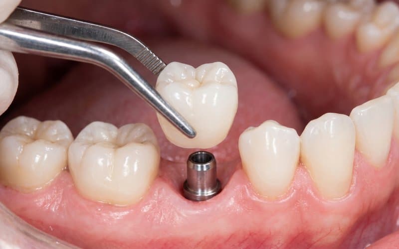 Dental implant screws with an abutment and a crown