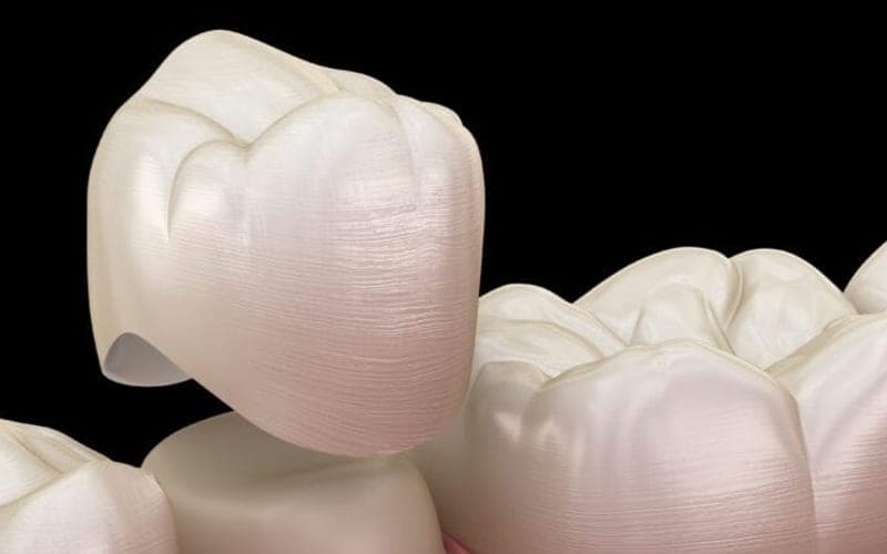 A dental crown being fitted over a prepared tooth